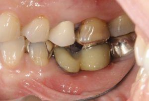 左下の奥歯にインプラントの治療を行う前の画像